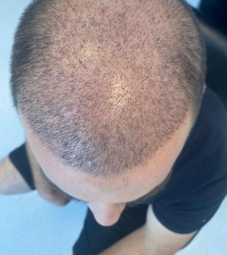 Estemia Hair Transplant